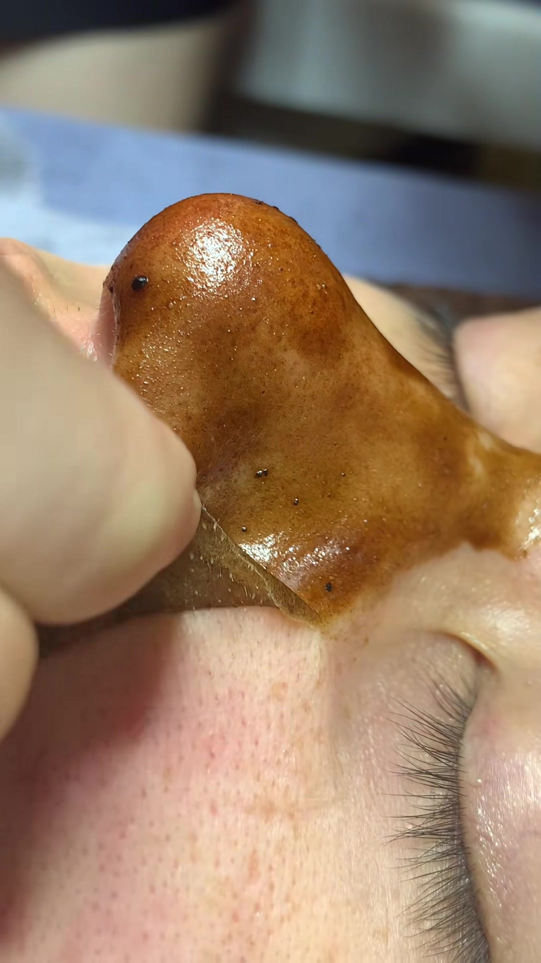 A different real treatment: the gold gel film lifting from the side of the nose